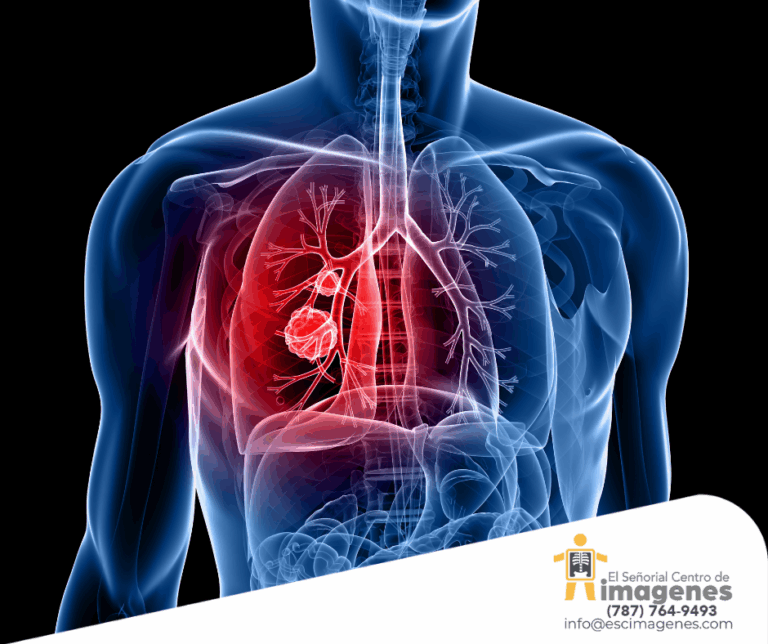 Lo que debes saber del cáncer de pulmón