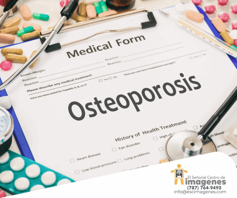 El 50% de las mujeres que alcanzan los 50 años de edad sufrirán algún tipo de fractura causada por la osteoporosis
