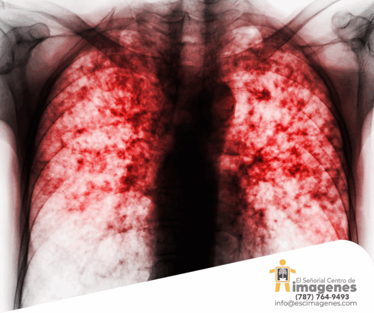 Pacientes con COVID prolongado tienen riesgo de desarrollar enfermedad pulmonar crónica