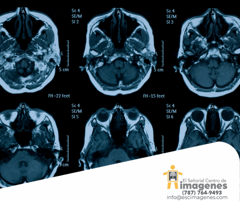 Uso del MRI para diagnosticar Alzheimer