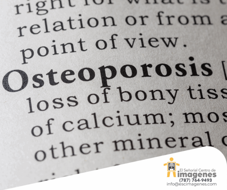 En riesgo de sufrir osteoporosis mujeres mayores de 50 años