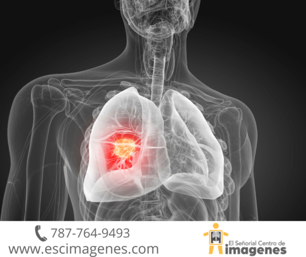 Incremento en detección temprana de cáncer de pulmón en Puerto Rico