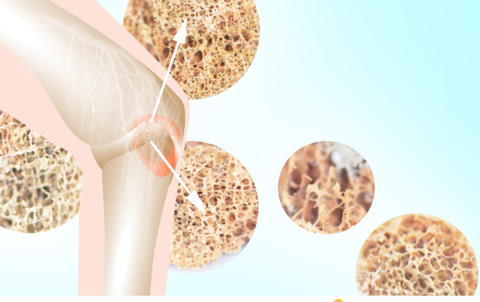Densitometría Ósea esencial para combatir la osteoporosis en Puerto Rico